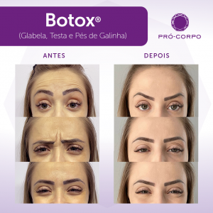 Botox ®: Fotos Antes e Depois